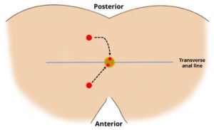 Fistula Treatment in Ghaziabad