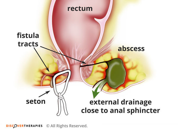 LOWER GASTROINTESTINAL TRACT BLEEDING