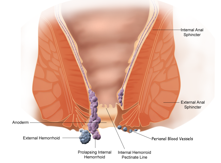 PRURITUS ANI (ITCHING IN ANAL REGION)