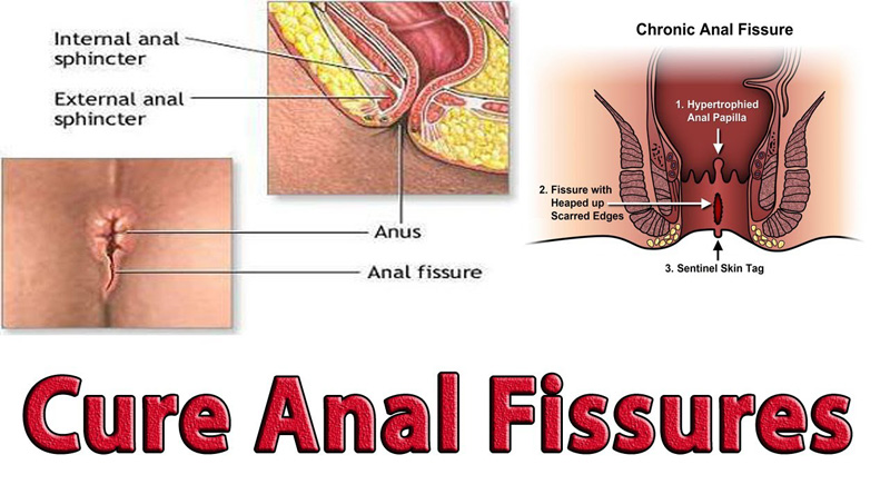 बवासीर / गुदा फिशर का इलाज का सबसे अच्छा तरीका क्या है?