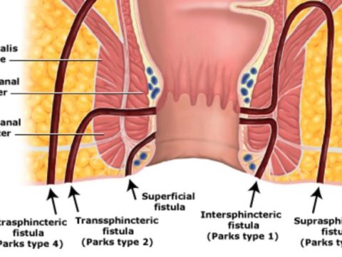 Fistula Treatment in Ghaziabad