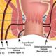 Fistula Treatment in Ghaziabad