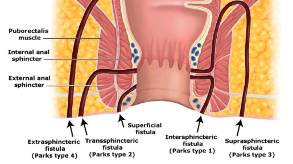 Fistula Causes And Symptoms