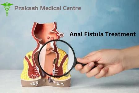 Your Complete Guide to Anal Fistula Treatment in Ghaziabad