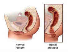 Prolapse Rectum