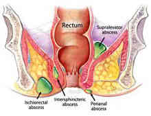 Peri Anal Abscess