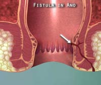 Fistula in Ano