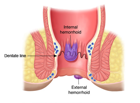 piles treatment hospital in delhi ncr