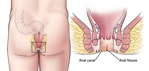 Treatment for fissure in delhi